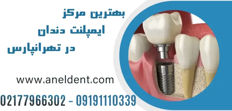 هزینه ایمپلنت دندان در تهرانپارس