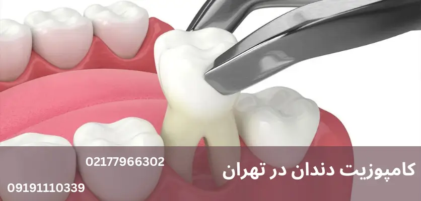 5 نکته کلیدی درباره کامپوزیت دندان در بارداری که باید بدانید