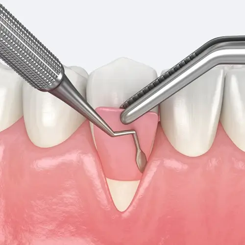 لیفت لثه در تهران