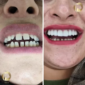 نمونه کار لمینت در تهران