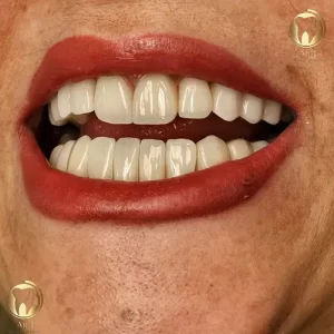 نمونه کار لمینت دندان در تهران