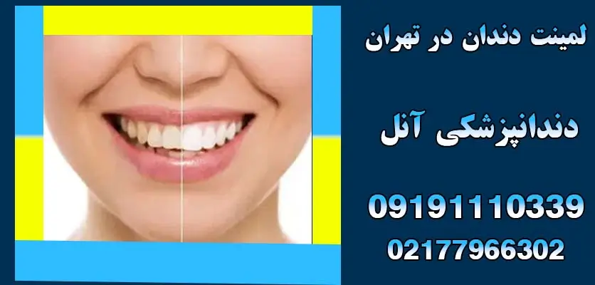 درمان زبان سفید و بوی دهان:4دلیل رایج سفید شدن زبان