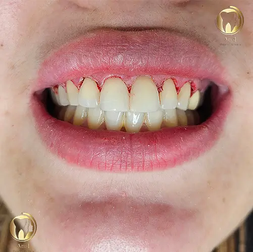 نمونه کار لیفت لثه در تهران کلینیک دندانپزشکی انل