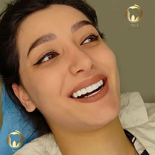 نمونه کار کامپوزیت در شرق تهران کلینیک دندانپزشکی آنل